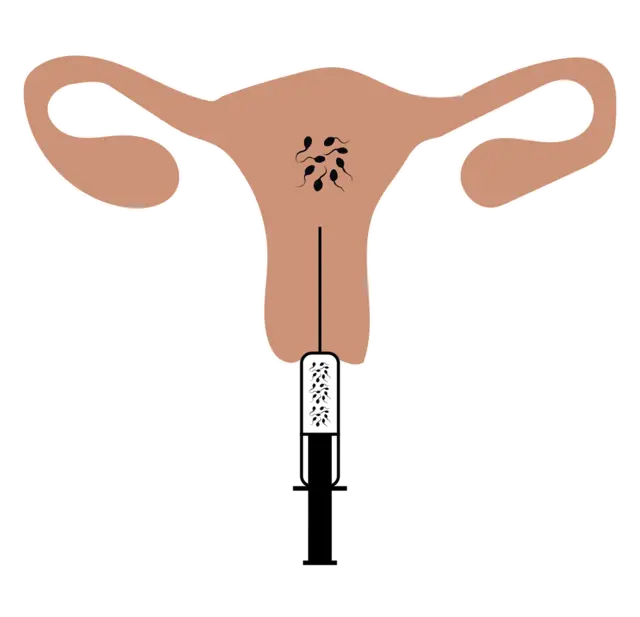 Intrauterine insemination illustration