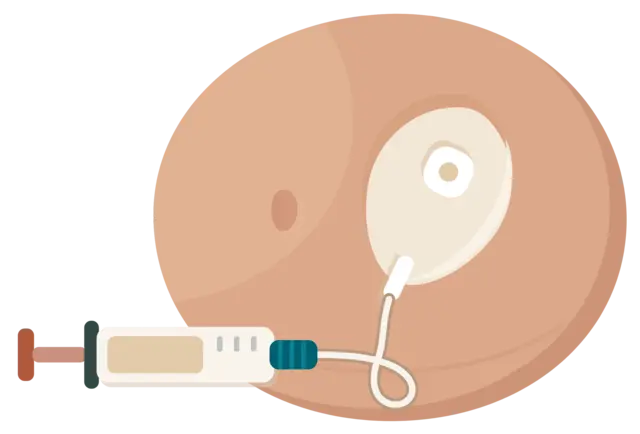 A wearable medication port with thin tubing connected to a syringe, replacing daily self-injections during IVF stimulation.