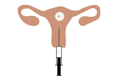 Service · Gestational surrogacy illustration