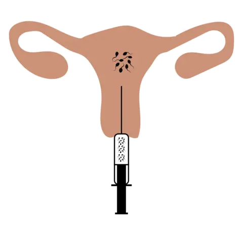 Intrauterine insemination illustration