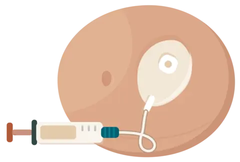 A wearable medication port with thin tubing connected to a syringe, replacing daily self-injections during IVF stimulation.