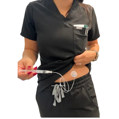 The NeriGuard needle-free catheter patch on a patient’s abdomen, connected to a small syringe held by a nurse