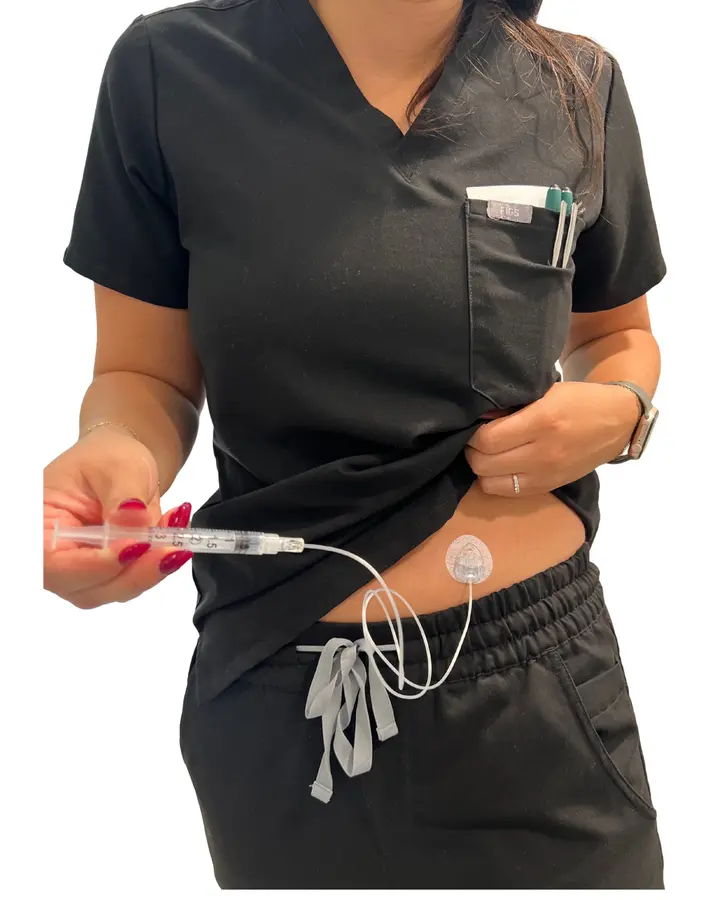 The NeriGuard needle-free catheter patch on a patient’s abdomen, connected by thin tubing to a small syringe held by a nurse