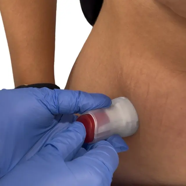 Clinician applying NeriGuard device to patient