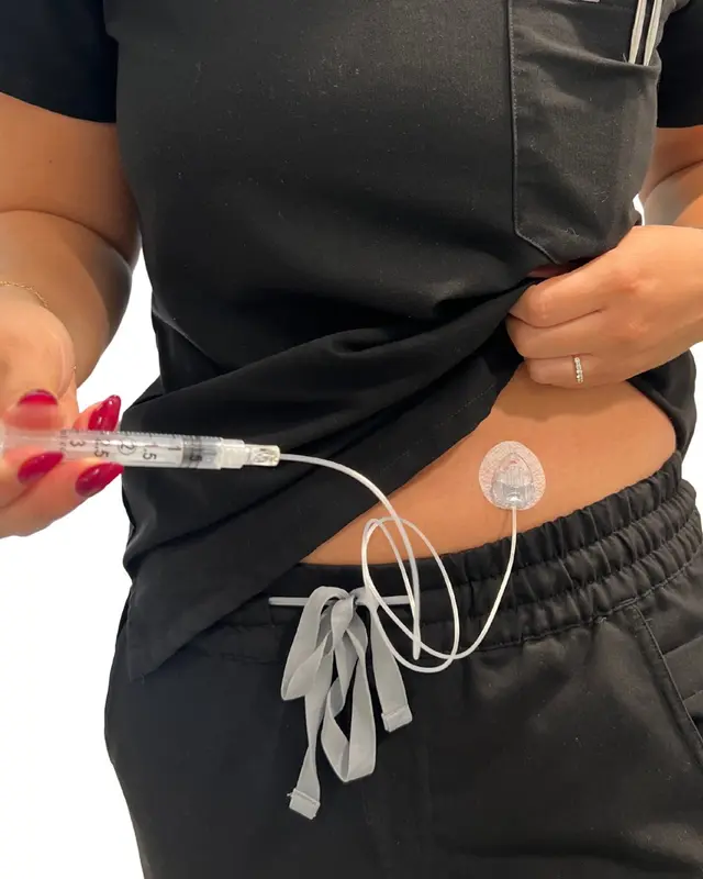 NeriGuard device worn on abdomen with syringe connected